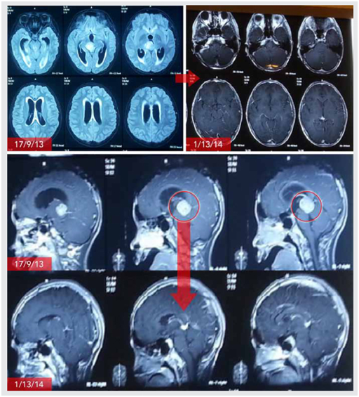 头痛伴随这些症状疑是脑肿瘤_医生在线警惕早期脑肿瘤的十大征兆