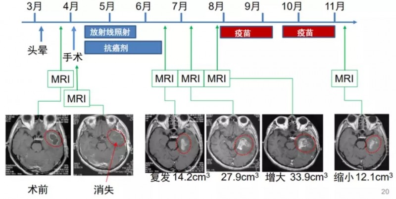 胶质细胞瘤临床案例