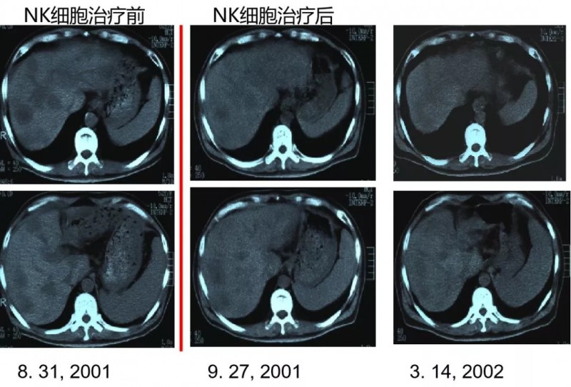 NK细胞疗法治疗结肠癌肝转移案例