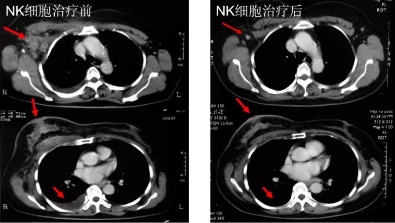 NK细胞疗法治疗晚期乳腺癌案例