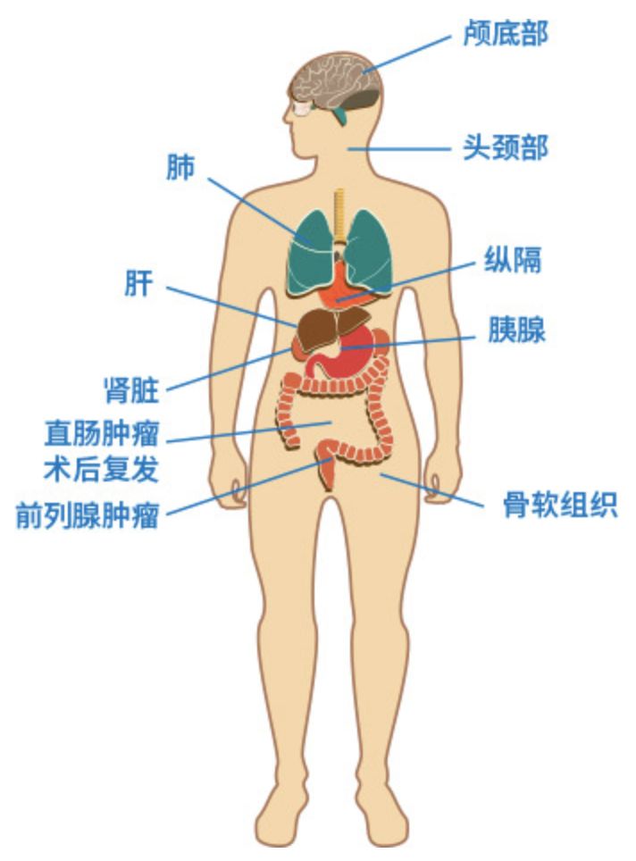 质子治疗适合的肿瘤人体图