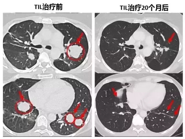 TIL细胞免疫治疗前后对比