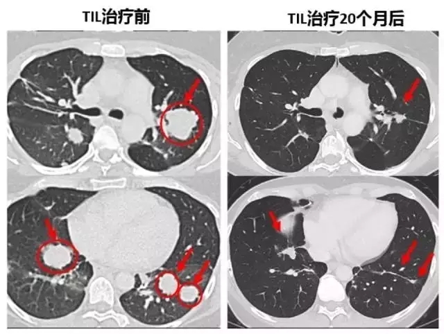 晚期胆管癌TILS之前前后对比