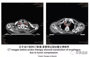 食管癌CT影像
