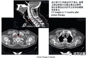 食管癌质子治疗后CT影像