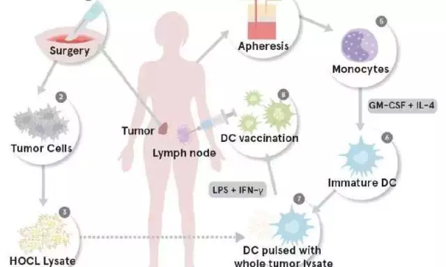 树突细胞疫苗-OCDC
