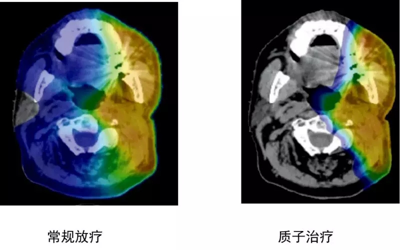 头颈部肿瘤常规放疗和质子治疗剂量分布图比较