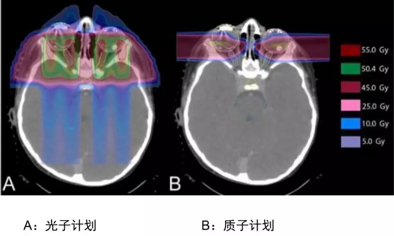 视网膜母细胞瘤光子治疗和质子治疗剂量分布图比较