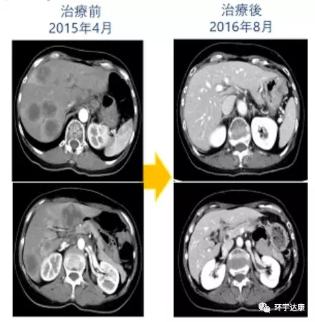 晚期肠癌肝转移患者WT1树突细胞疫苗治疗