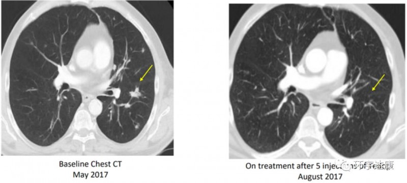 晚期肺癌患者在经过5次的疫苗注射后，肿瘤迅速缩小