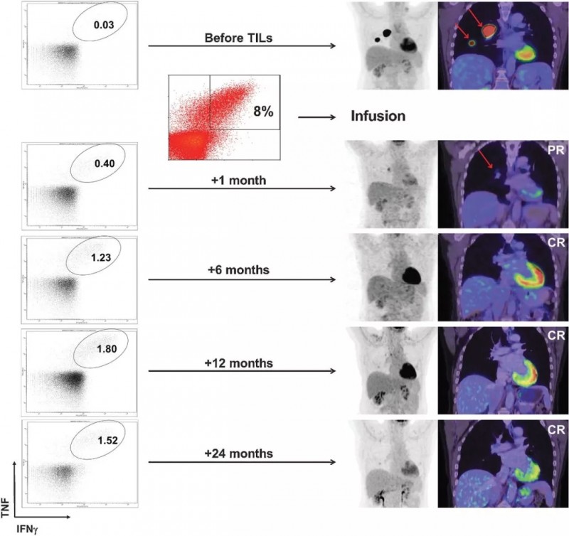 黑色素瘤TIL疗法治疗后的影像