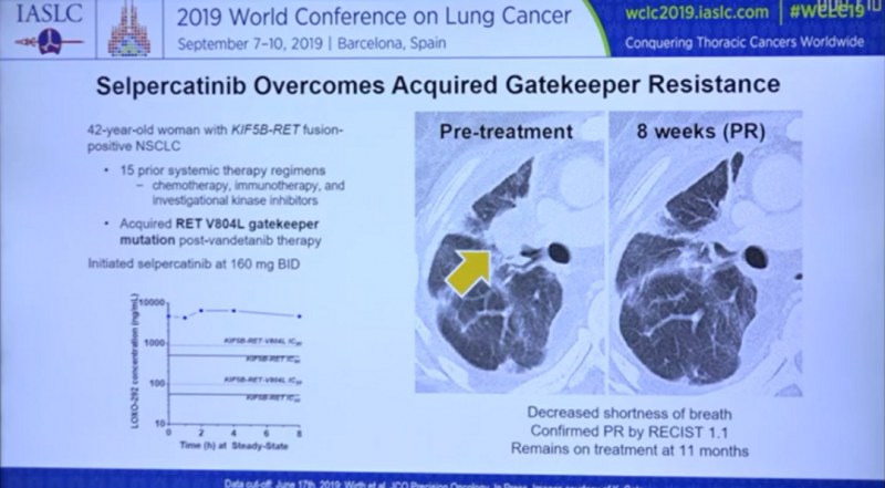 Selpercatinib治疗非小细胞肺癌案例