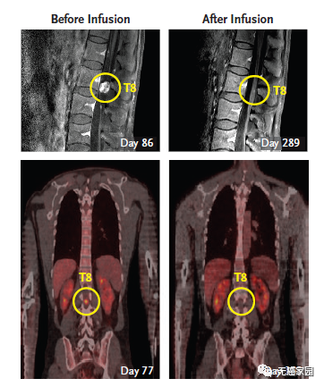脑瘤第二轮CAR-T治疗后脊索内肿瘤剧烈萎缩