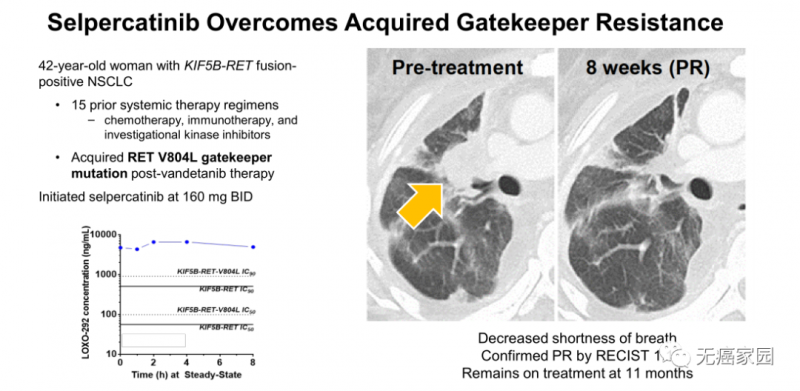 Selpercatinib治疗女性非小细胞肺癌患者案例