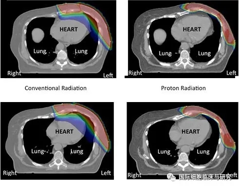 乳腺癌质子放疗和光子放疗放射剂量对比