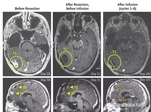 CAR-T技术治疗脑胶质瘤案例