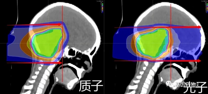 质子治疗和光子治疗对比