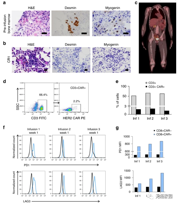 CAR-T疗法治疗横纹肌肉瘤效果