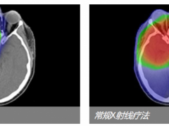 肺癌脑转移的治疗,肺癌脑转移怎么办,肺癌脑转移怎么治疗,肺癌脑转移的治疗方案