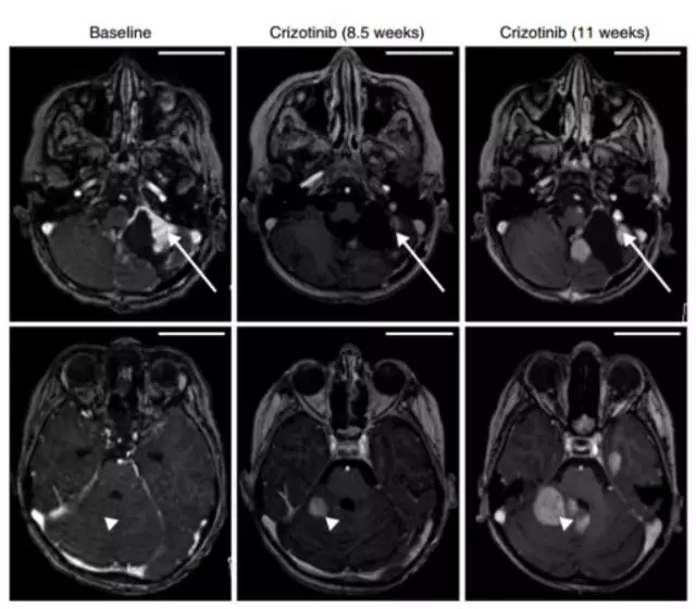 MET抑制剂治疗脑瘤效果