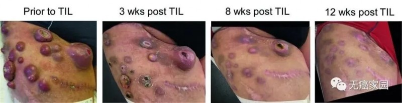 乳腺癌TILS疗法治疗前后对比