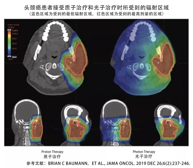 头颈癌质子治疗和光子治疗辐射区域对比