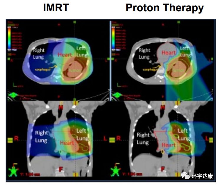 质子治疗肺癌和传统放疗对比