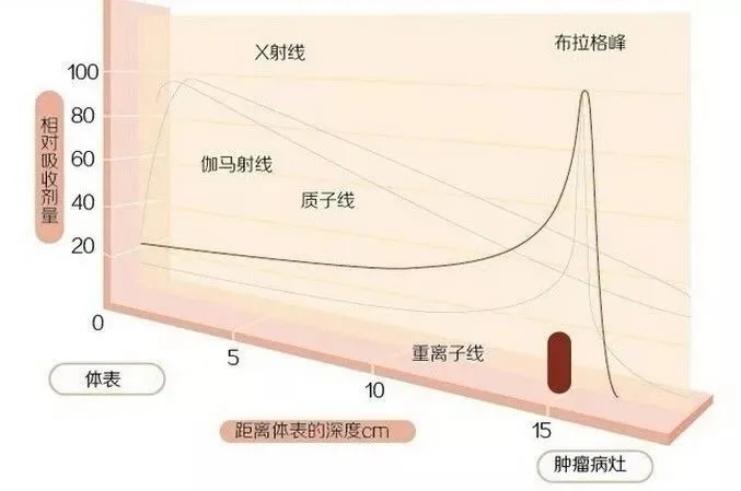 质子束疗法（PBT）—先进的放射治疗