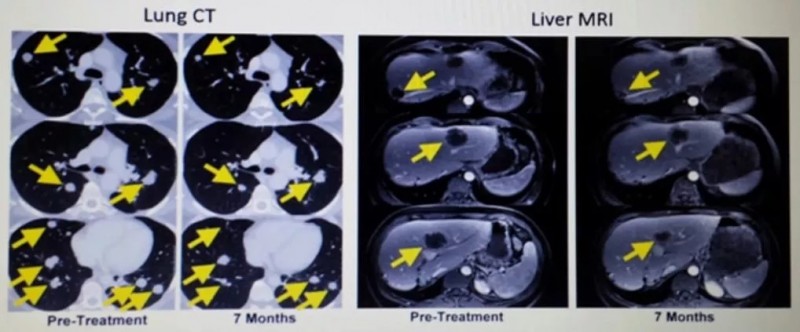 肿瘤浸润淋巴细胞治疗前后的CT与MRI对比图