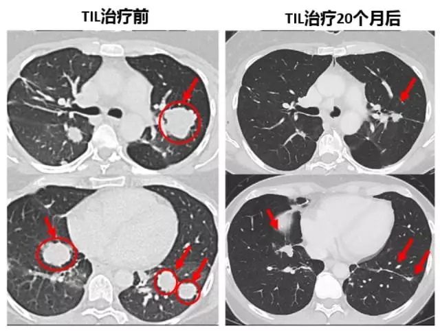 肿瘤浸润淋巴细胞治疗前后对比