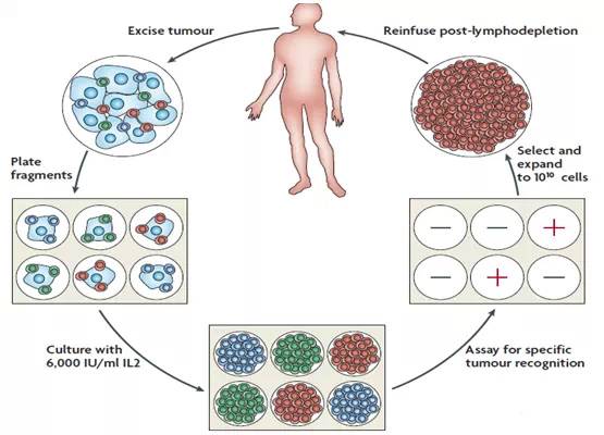肿瘤浸润淋巴细胞治疗过程