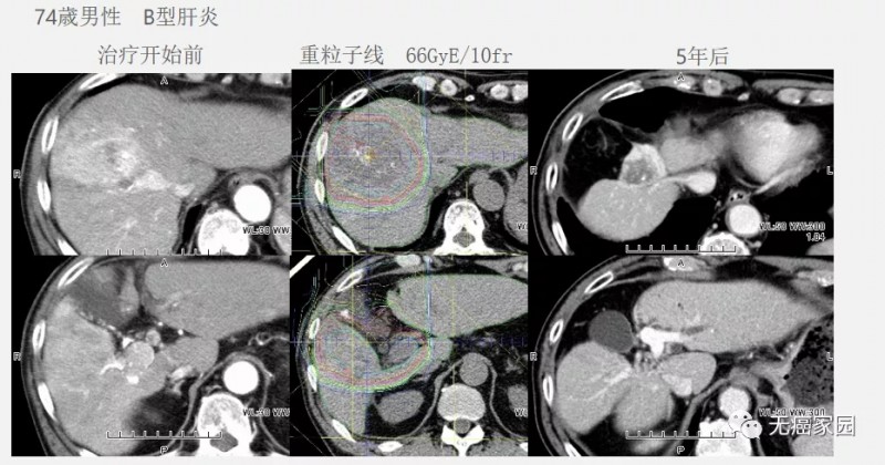 重离子治疗肝癌前后对比