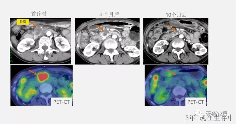 质子重离子治疗胰腺癌前后对比