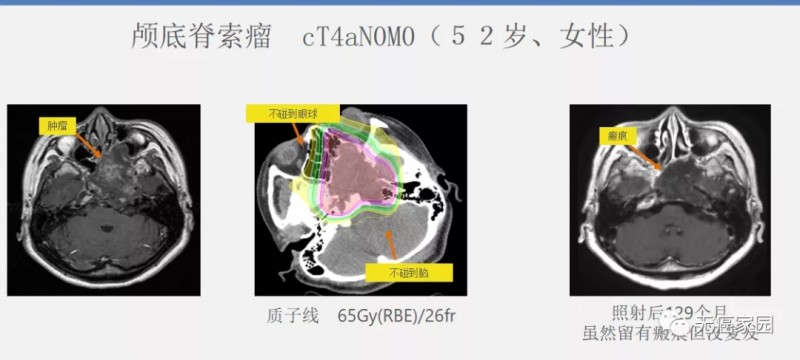 质子治疗颅低脊索瘤前后对比