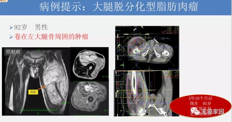 质子重离子治疗大腿蜕分化型脂肪肉瘤前后对比