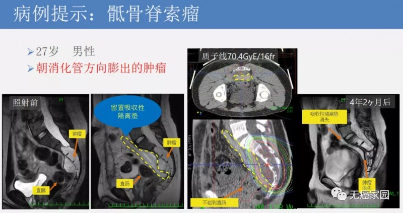 质子重离子治疗骶骨脊索瘤前后对比