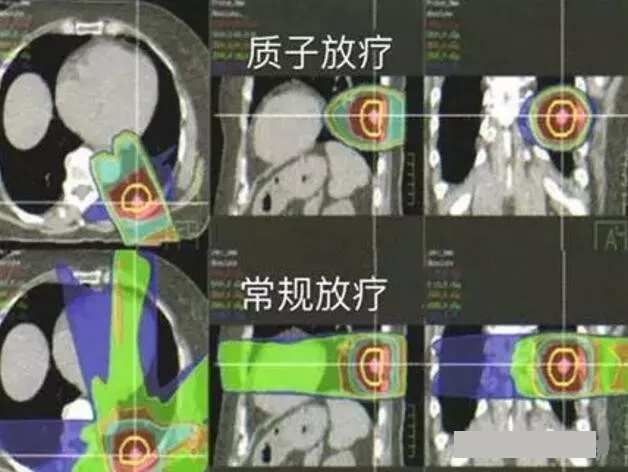 肺癌质子治疗和传统放疗对比