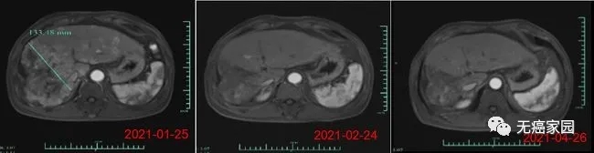 CAR-T细胞免疫疗法治疗肝癌患者的MRI结果示意图