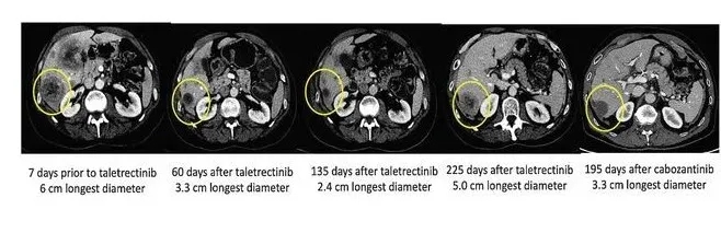 Taletrectnib治疗晚期肺癌脑转移效果