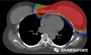 质子治疗乳腺癌照射面积