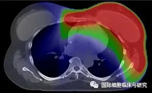 X线放疗治疗乳腺癌照射面积