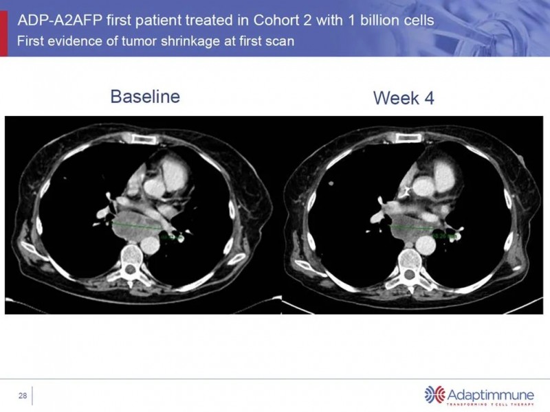 ADP-A2AFP治疗前后对比