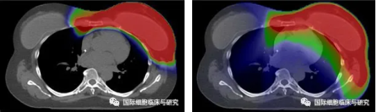 乳腺癌质子治疗和传统放疗对比