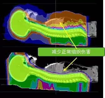 儿童髓母细胞瘤质子治疗和传统X线放疗对比