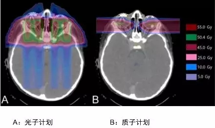 儿童视网膜母细胞瘤质子治疗和光子放疗对比