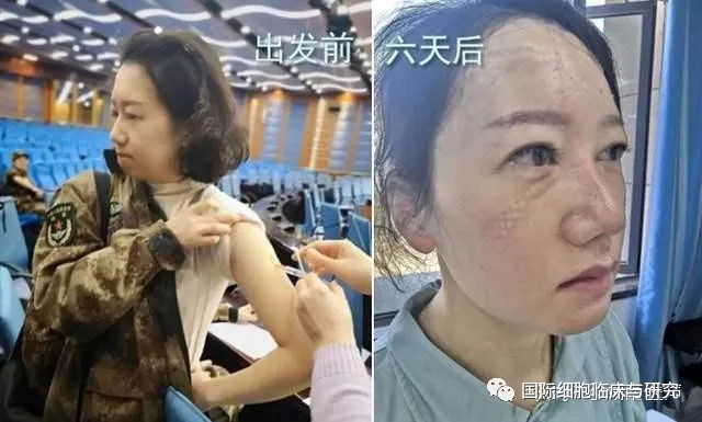 使用胸腺肽前后对比