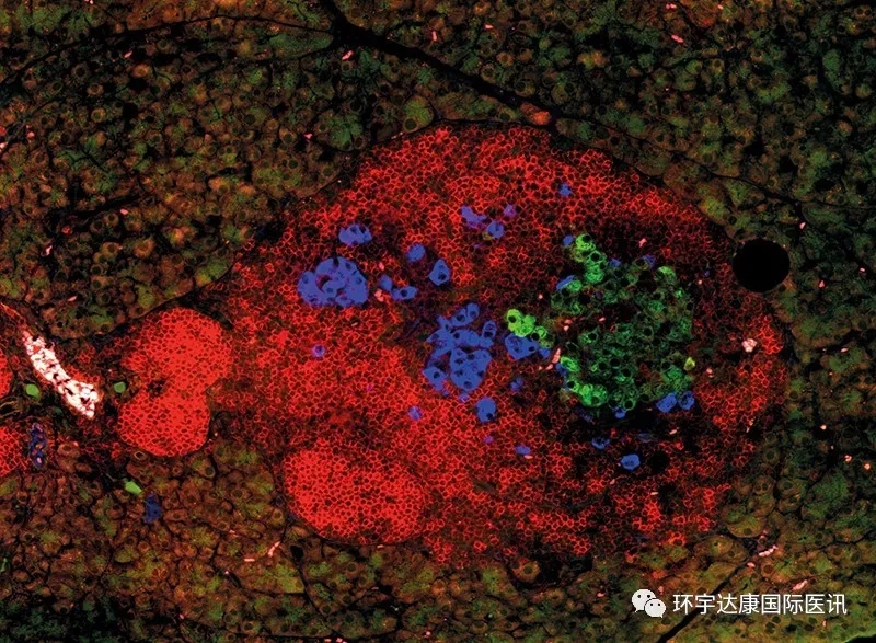 免疫细胞攻击胰岛中的β细胞