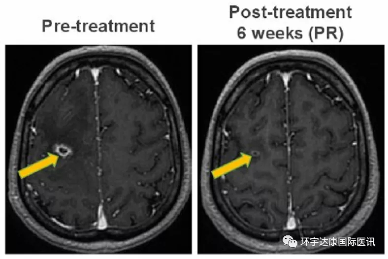 AB-106治疗肺癌脑转移的效果