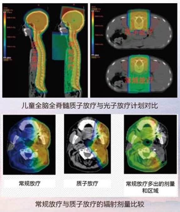 常规放疗与质子放疗的辐射剂量比较