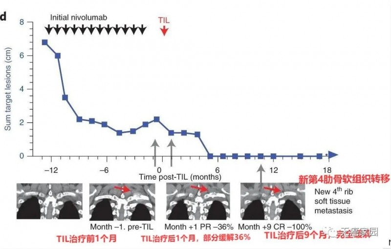 TIL细胞疗法治疗前后对比